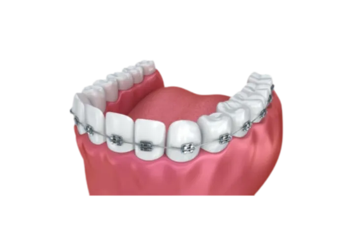 Brackets de ortodoncia